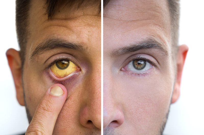 Adult jaundice assessment