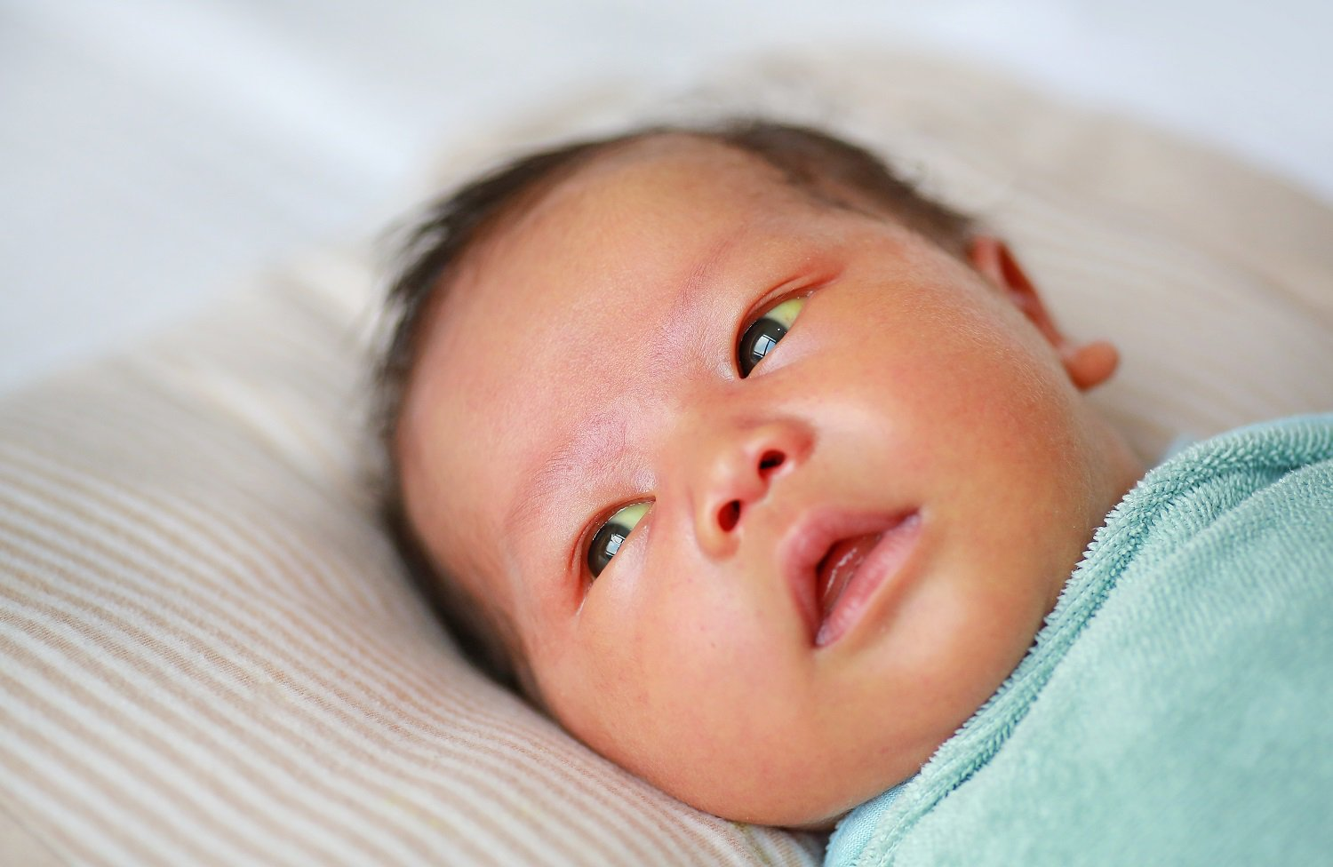 Baby with jaundice