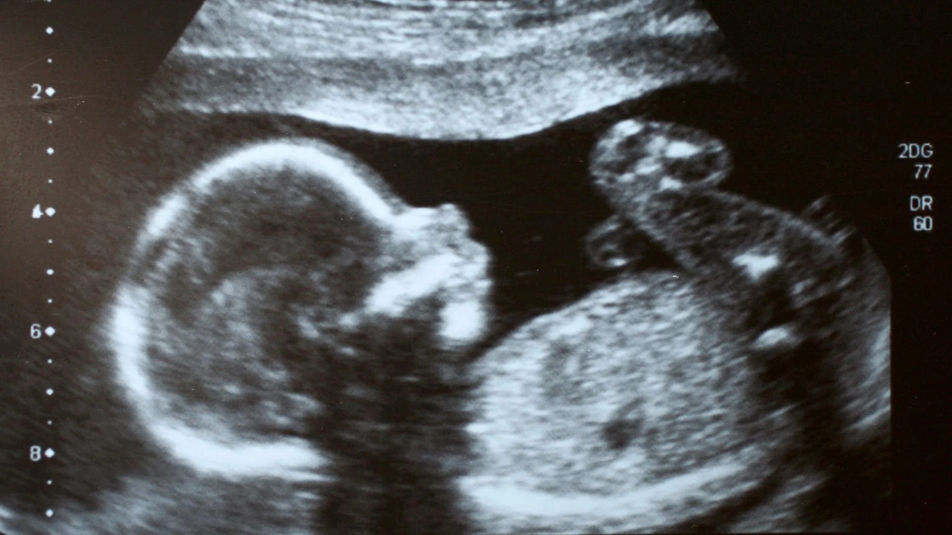 Detailed pregnancy ultrasound assessment