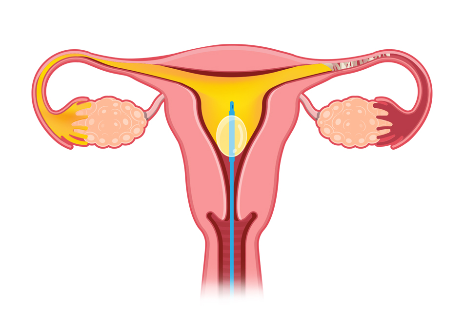 HyCoSy fertility assessment illustration