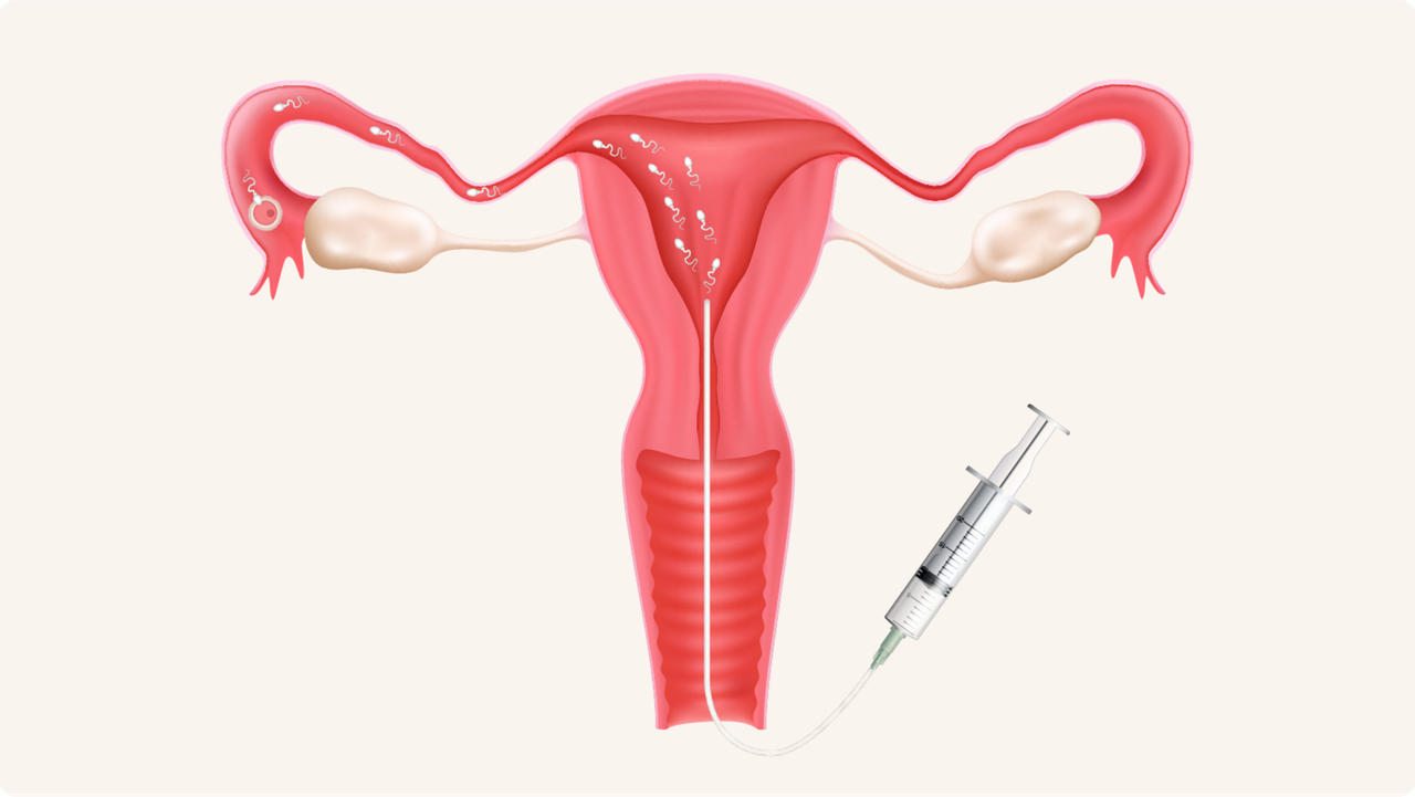 Intrauterine insemination treatment illustration